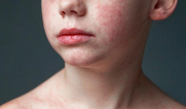 Gezicht van een kind met mazelen